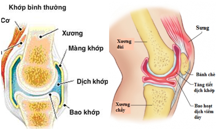 Viêm bao hoạt dịch